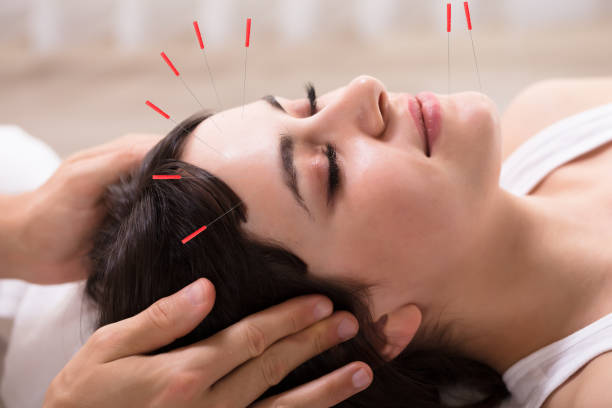 Relaxed Young Woman Receiving Acupuncture Treatment In Beauty Spa